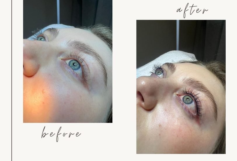 Acne & Scar Treatments