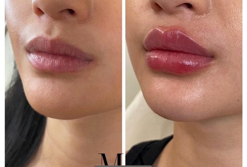 Lips Treatments