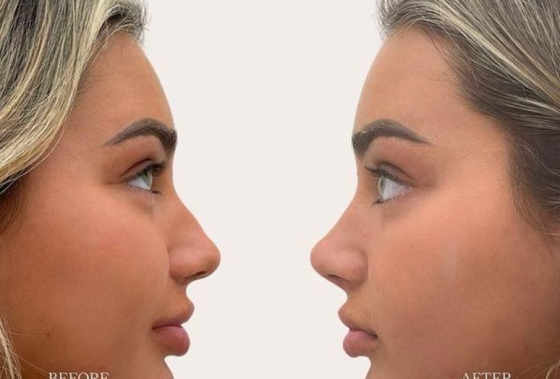 Double Chin & Jawline Contouring