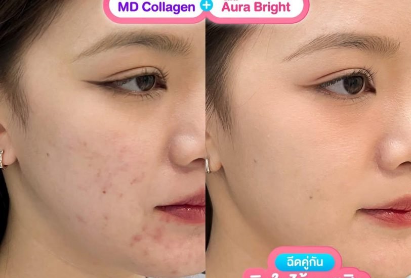Skin Rejuvenation