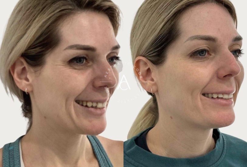 Facial Contouring & Lifting