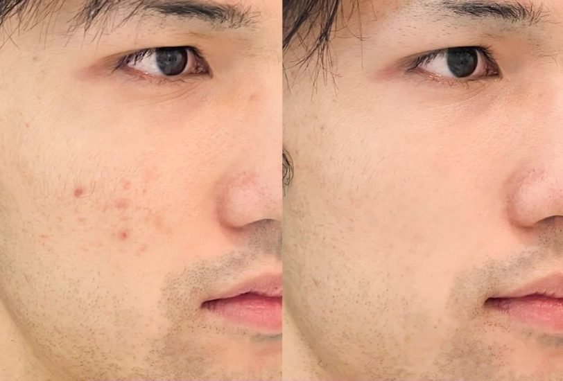Acne & Scar Treatments