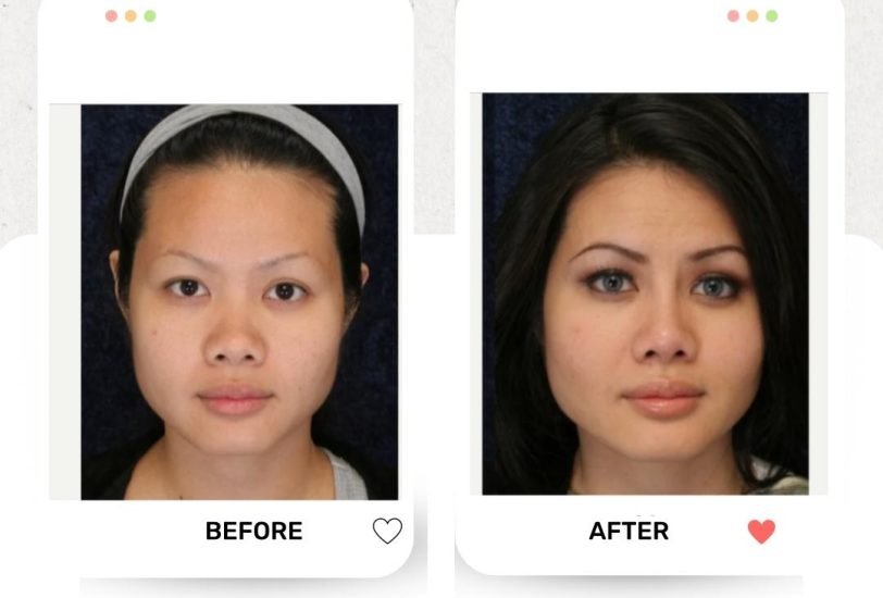 Facial Contouring & Lifting