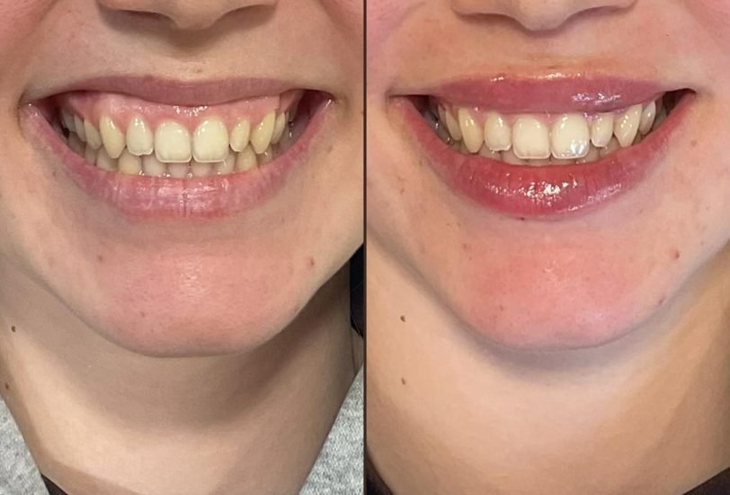Lips Treatments