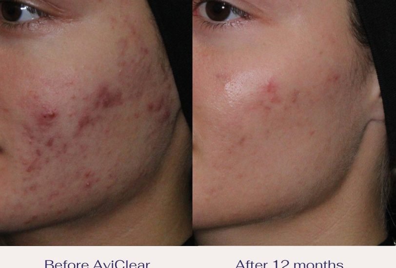 Acne & Scar Treatments