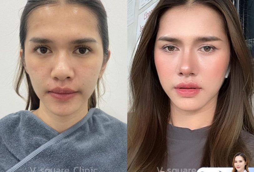 Injectable Treatments