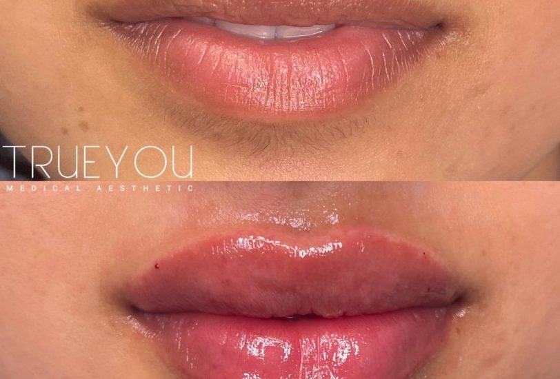 Lips Treatments