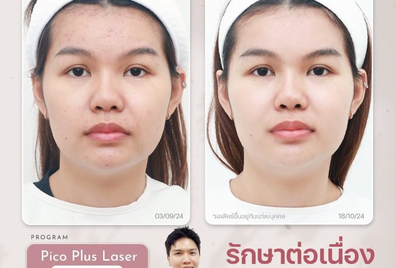 Facial Contouring & Lifting