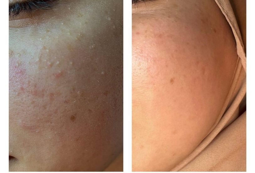 Acne & Scar Treatments