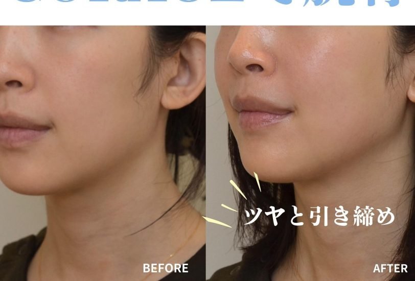 Fat Reduction Injections