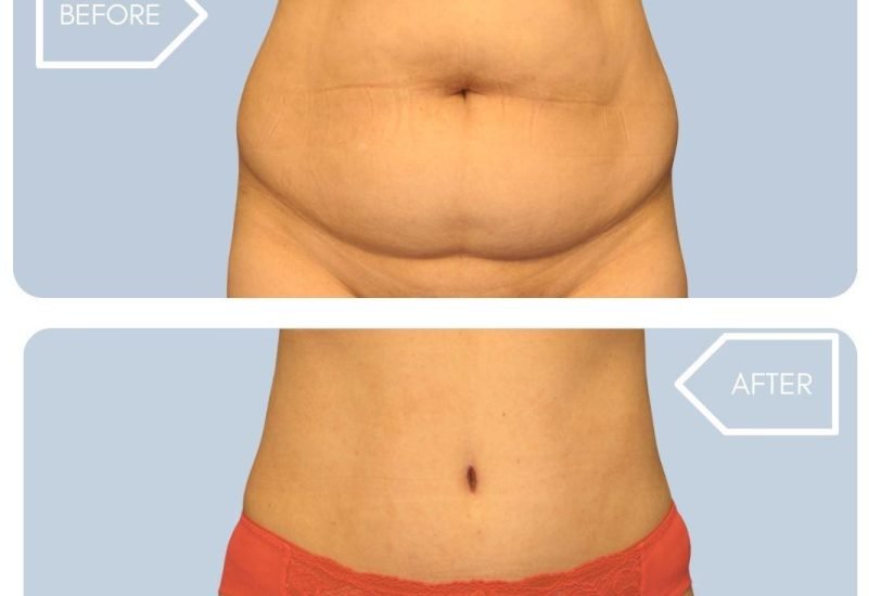 Fat Transfer