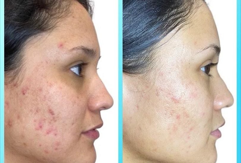 Acne & Scar Treatments