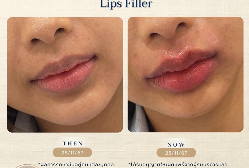 Lips Treatments