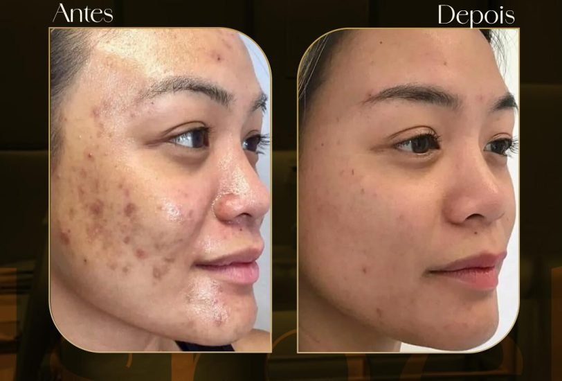 Acne & Scar Treatments