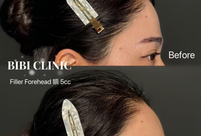 Facial Contouring & Lifting