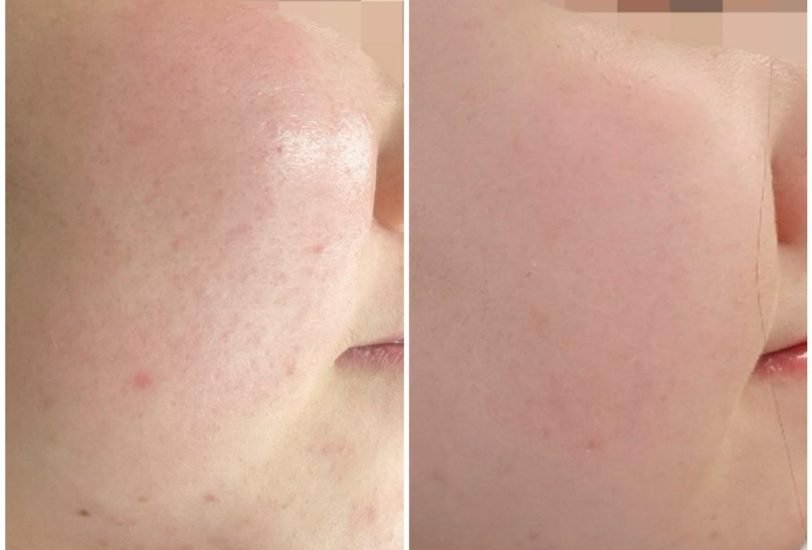 Acne & Scar Treatments