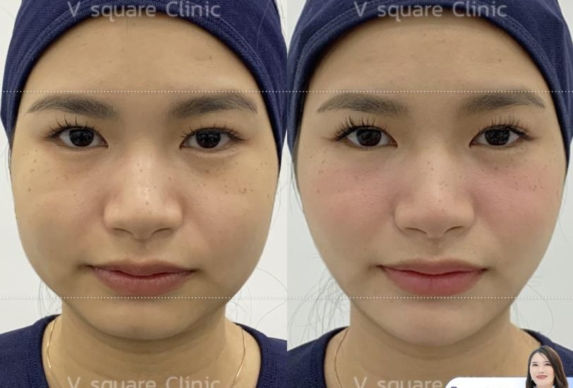 Double Chin & Jawline Contouring