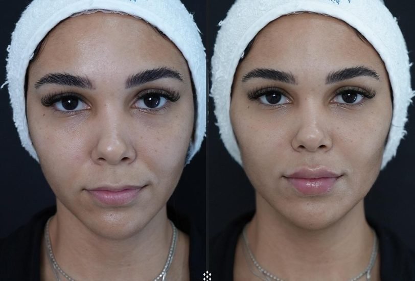 Facial Contouring & Lifting