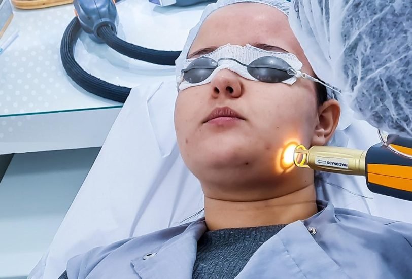 Laser Hair Removal