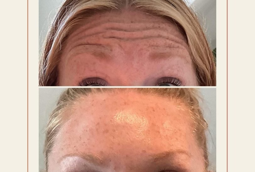Anti-Aging Treatments