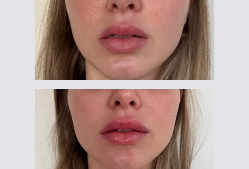 Lips Treatments