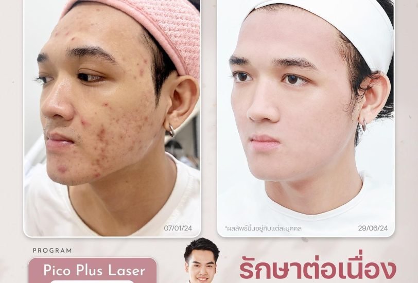 Acne & Scar Treatments