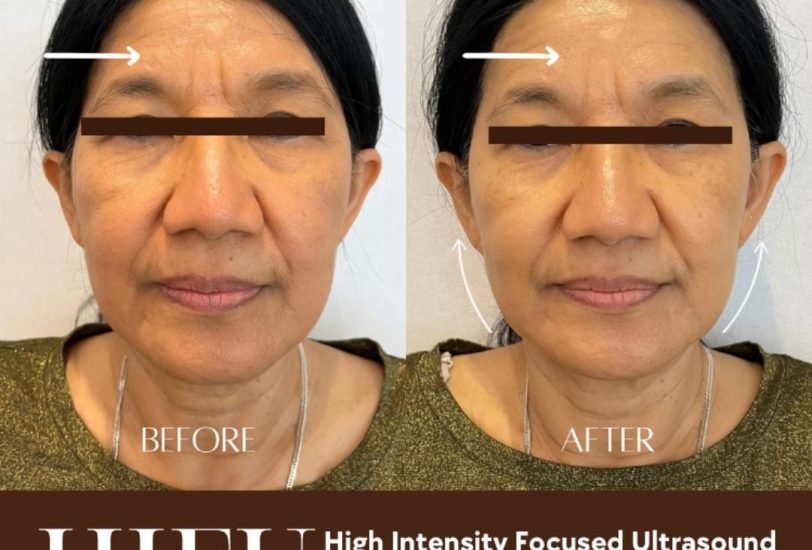 Injectable Treatments