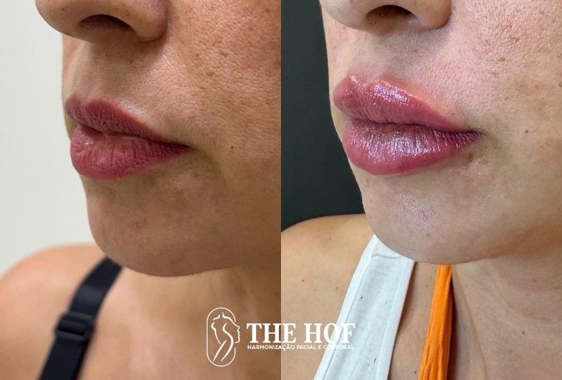 The Hof Clinic 2 – VerifiedCare Lips Treatments