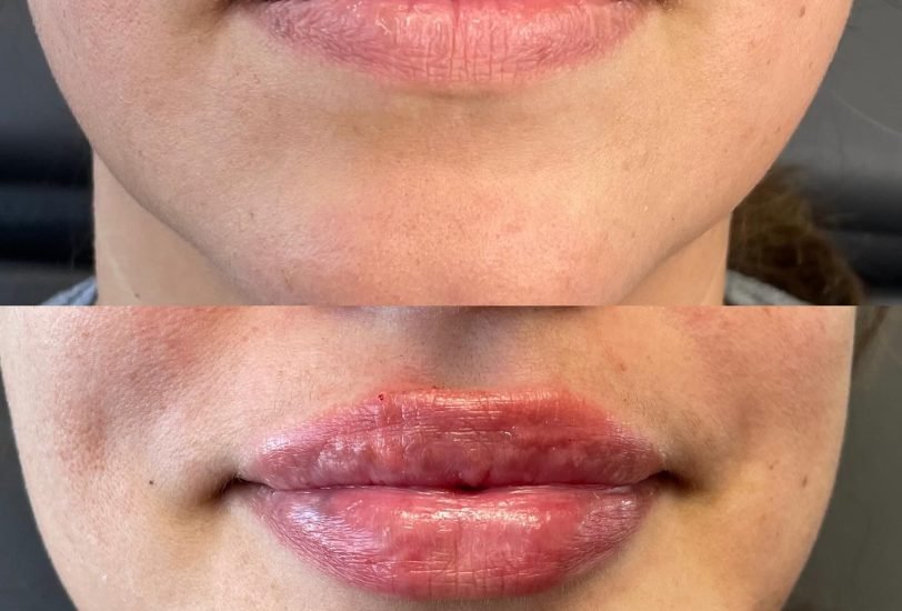 Lips Treatments