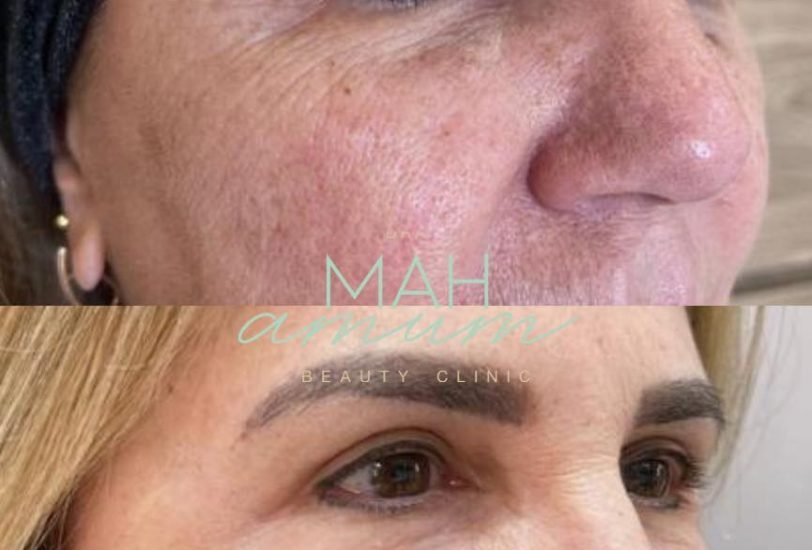 Injectable Treatments