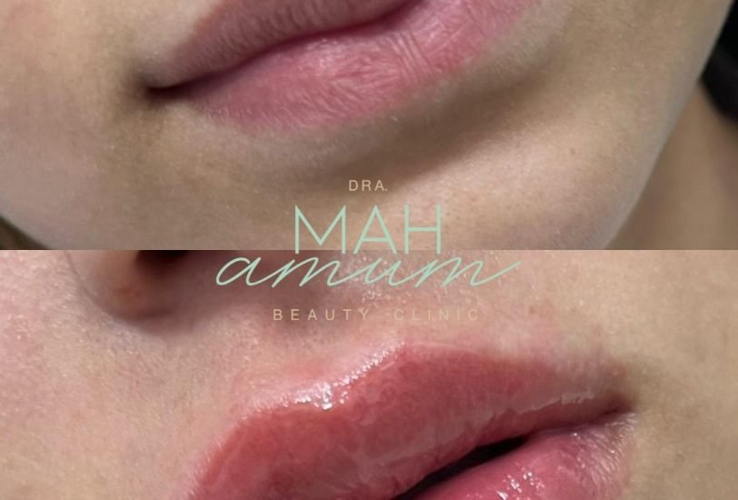 Lips Treatments