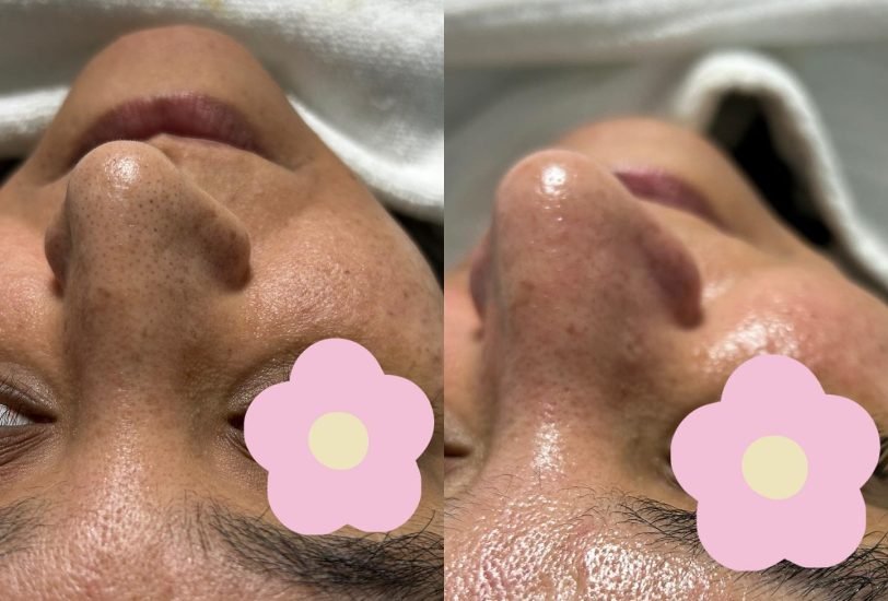Pore & Texture Refinement