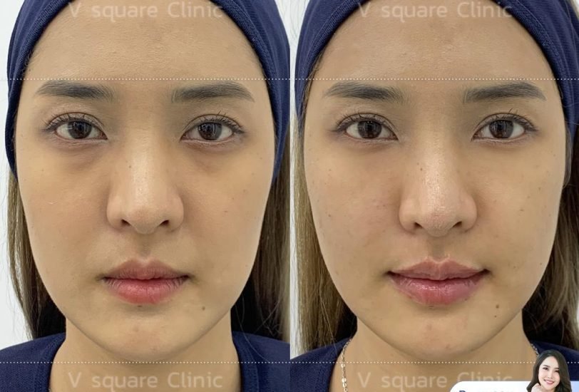 Facial Contouring & Lifting