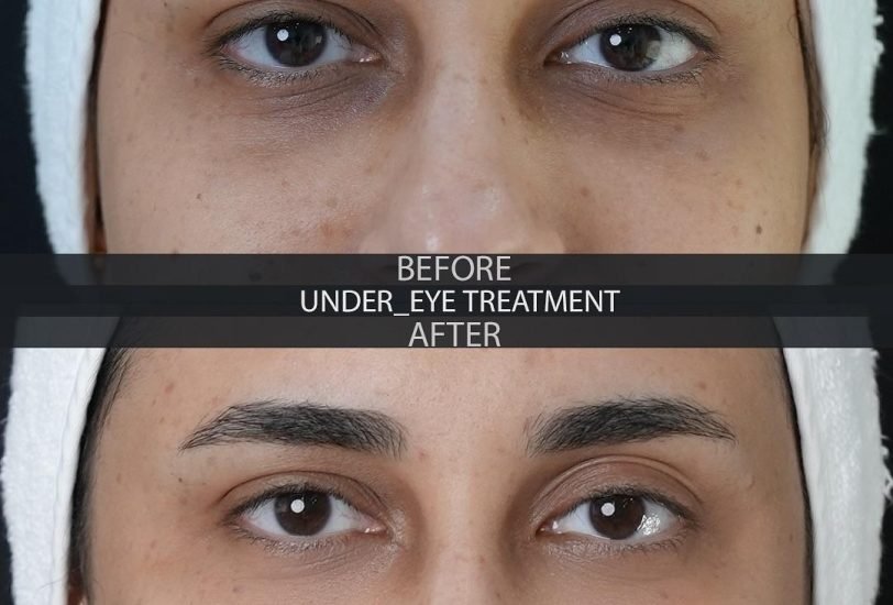Eye Rejuvenation