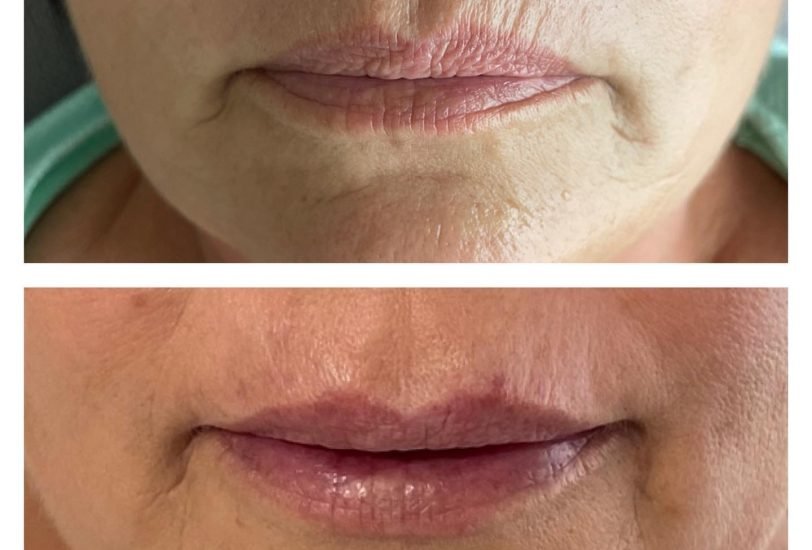 Lips Treatments