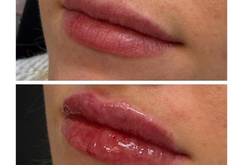 Lips Treatments