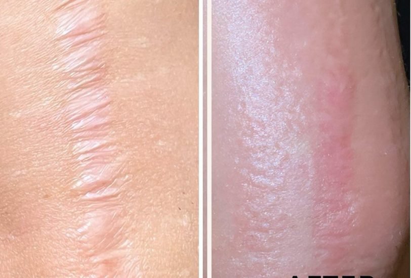 Scar Revision Treatments