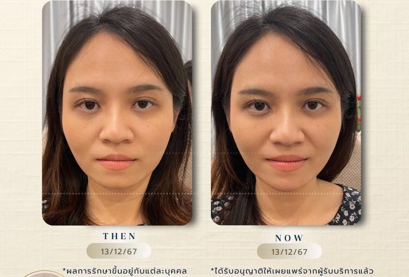 Injectable Treatments