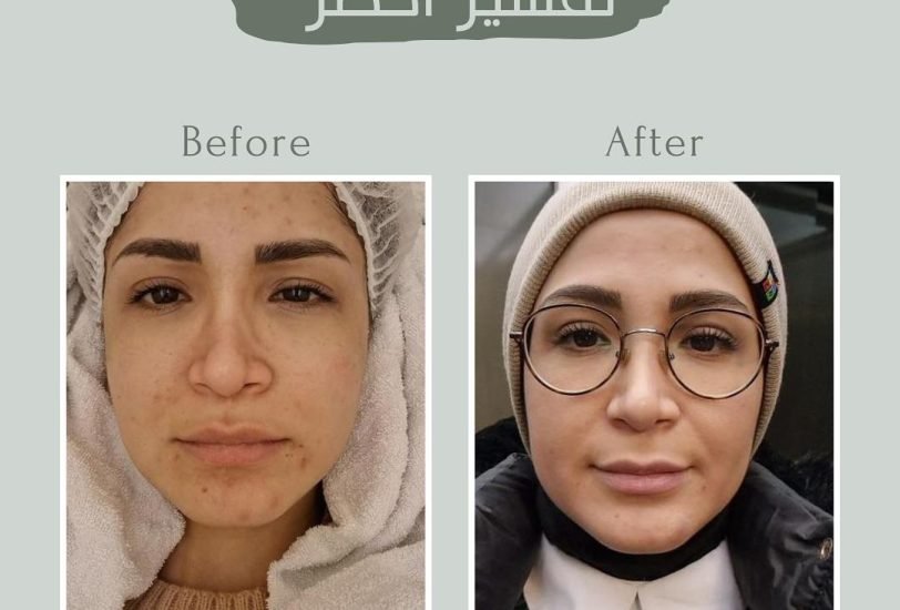 Pore & Texture Refinement