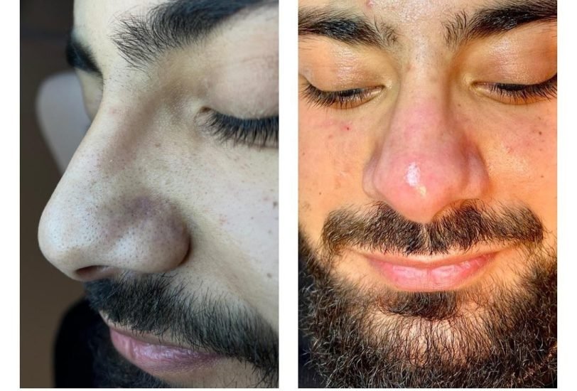 Laser Hair Removal