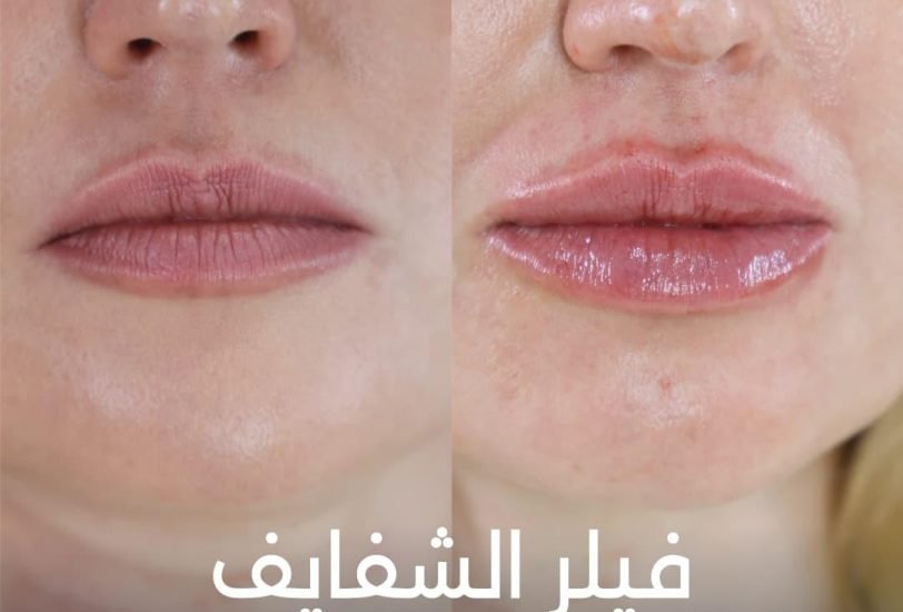 Lips Treatments