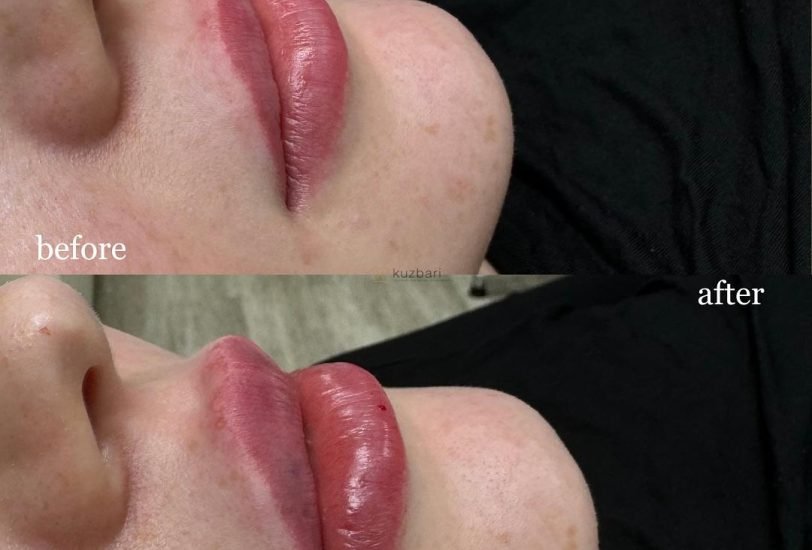 Lips Treatments