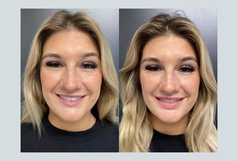 Injectable Treatments