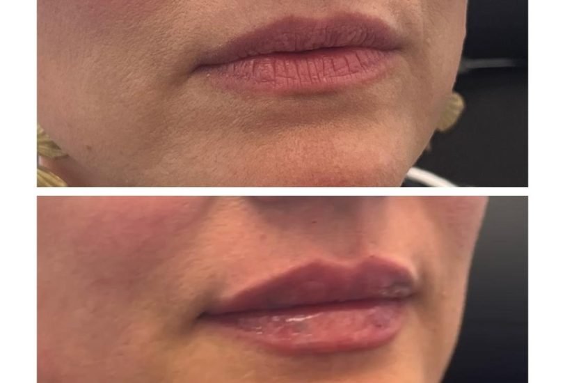 Injectable Treatments