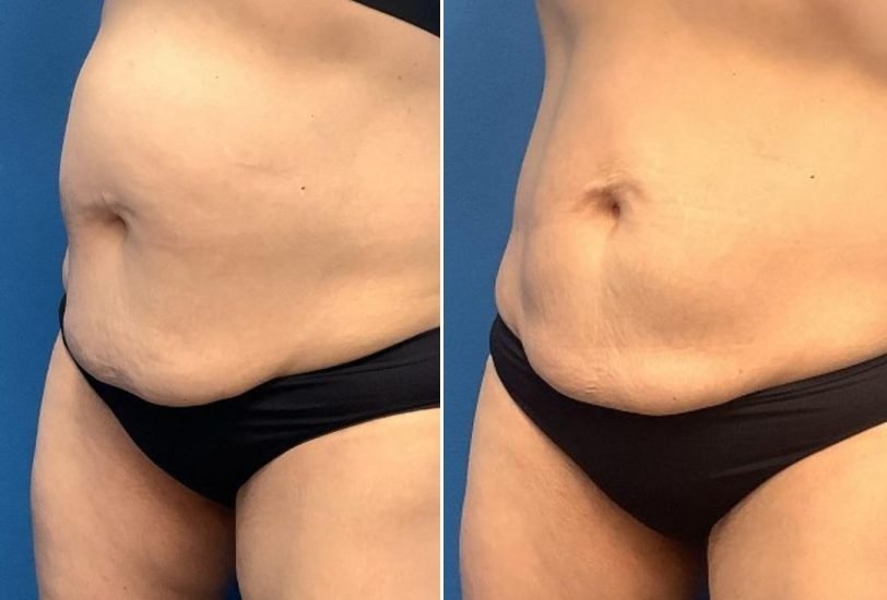 Cellulite Reduction