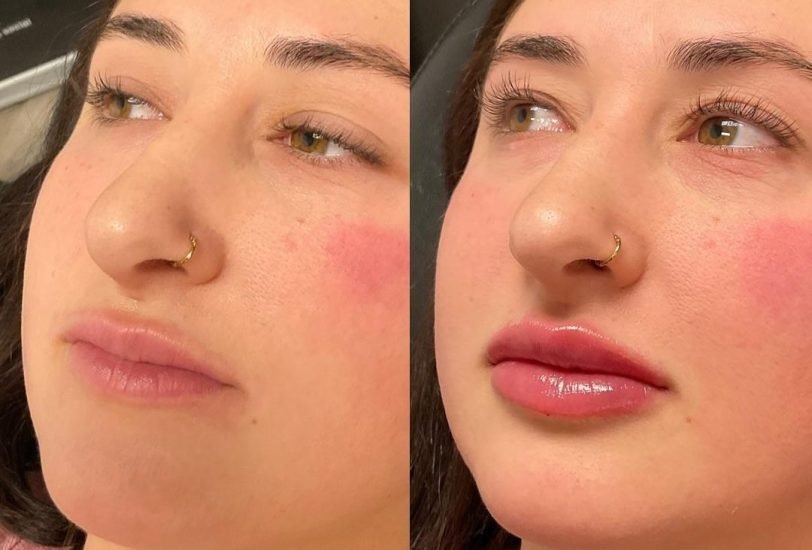Injectable Treatments