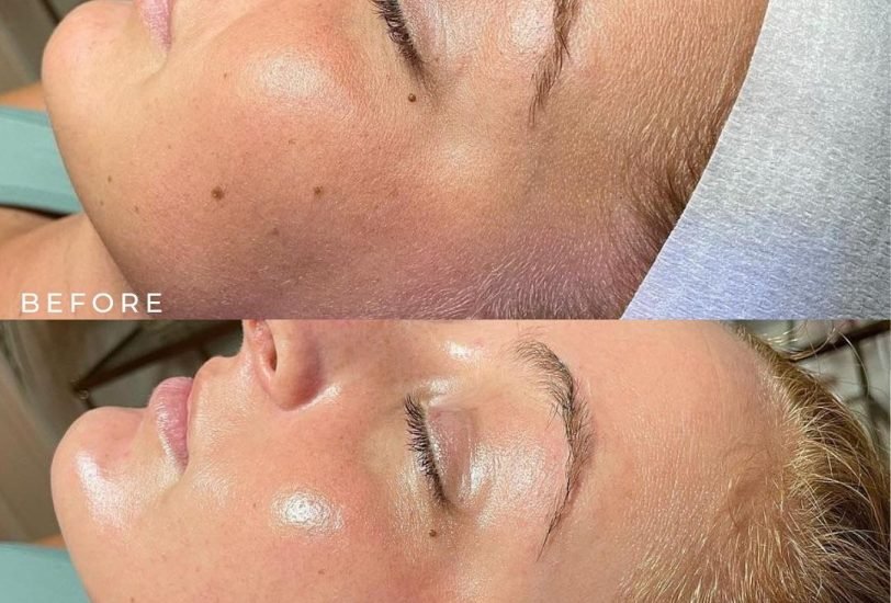 Skin Rejuvenation