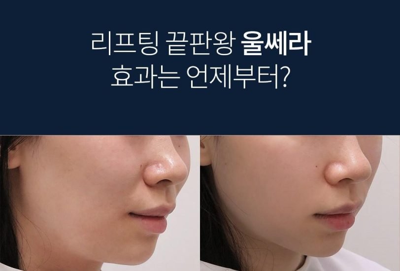 Facial Contouring & Lifting