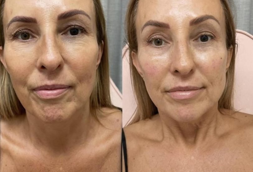 Skin Tightening