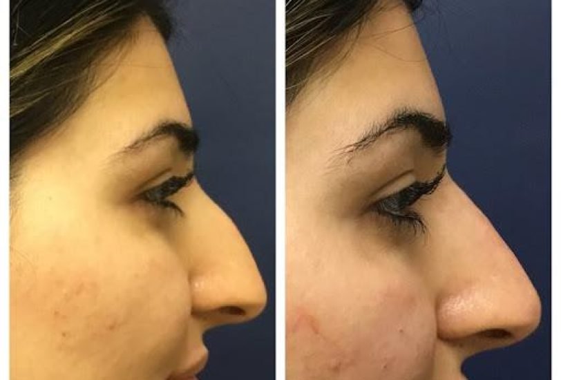 Facial Contouring & Lifting